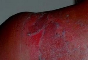 Изгаряне на кожата | Ayurveda Bansko