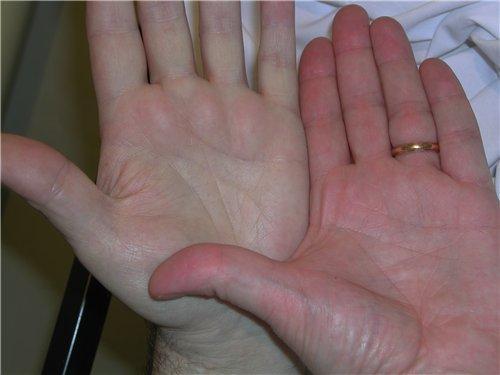 Treatment of Anemia with Ayurveda | Ayurveda Bansko